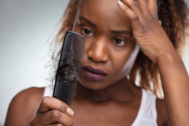 Hair Fall imag